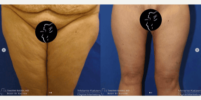 Case 7032 - 45-54 year old woman treated with Thigh Lift
