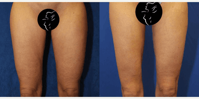 Case 7033 - 35-44 year old woman treated with Thigh Lift