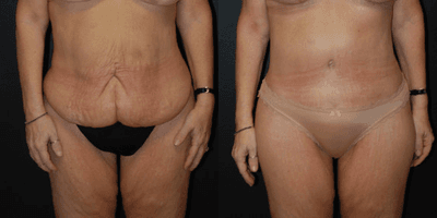 Case 7034 - 52 year old woman treated with Thigh Lift