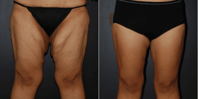 Case 7035 - Woman treated with Thigh Lift