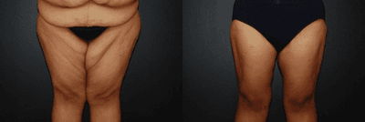 Case 7036 - Woman treated with Thigh Lift