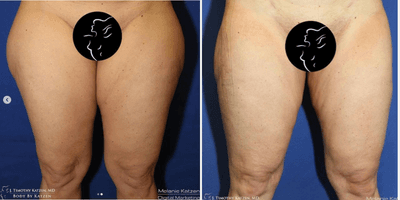 Case 7037 - 25-34 year old woman treated with Thigh Lift