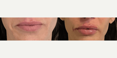 Case 7283 - Woman treated with Restylane Kysse, Juvederm, Lip Fillers