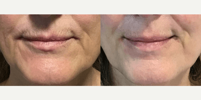 Case 7284 - Woman treated with Restylane Kysse, Juvederm, Lip Fillers