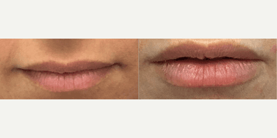 Case 7285 - Woman treated with Lip Fillers