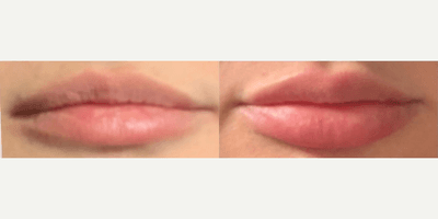 Case 7286 - Woman treated with Lip Fillers