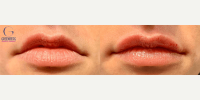 Case 7287 - Woman treated with Lip Fillers, Restylane
