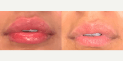 Case 7288 - Woman treated with Lip Fillers, Restylane