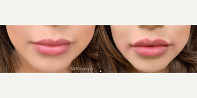 Case 7289 - Woman treated with Lip Fillers