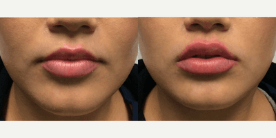 Case 7290 - Woman treated with Juvederm, Lip Fillers