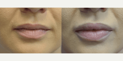 Case 7291 - Woman treated with Juvederm, Lip Fillers