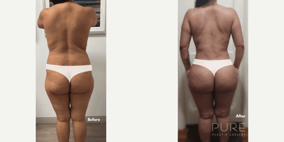Woman treated with Brazilian Butt Lift