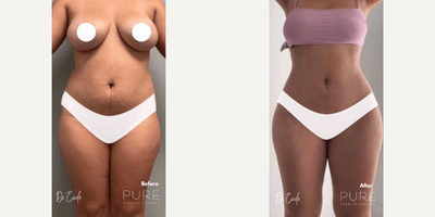 Woman treated with Brazilian Butt Lift