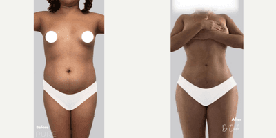 Woman treated with Brazilian Butt Lift