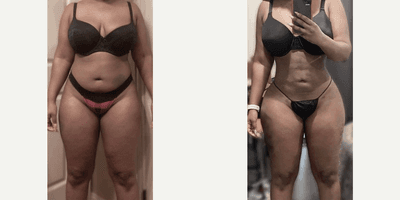 Woman treated with Brazilian Butt Lift