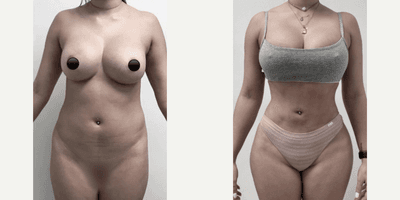 Woman treated with Brazilian Butt Lift