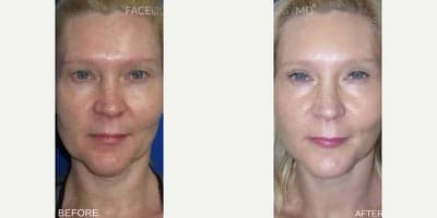 Case 7791 - Woman treated with Facelift, CO2 Laser, Eyelid Surgery
