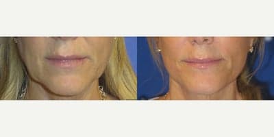 Case 7792 - Woman treated with Facelift