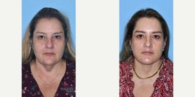 Case 7793 - Woman treated with Facelift