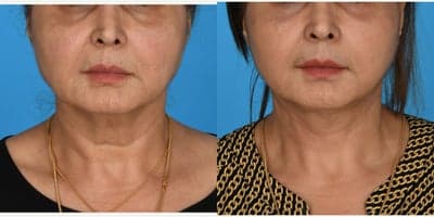 Case 7794 - 55-64 year old woman treated with Facelift, Mini Facelift, SMAS Facelift, Lower Facelift, Neck Lift, Deep Plane Facelift