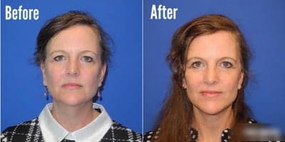 Case 7795 - Woman treated with Facelift