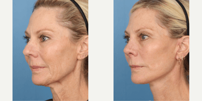 Case 7796 - 55-64 year old woman treated with Facelift, Rhinoplasty