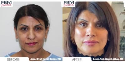 Case 7798 - 45-54 year old woman treated with Facelift, Mini Neck Lift, Double Eyelid Surgery, Facial Fat Transfer