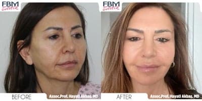 Case 7799 - 45-54 year old woman treated with Facelift, Eyelid Surgery