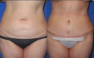 Case 8 - Woman treated with Tummy Tuck