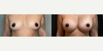 Woman treated with Breast Implants