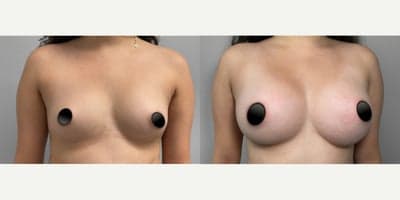 Woman treated with Breast Implants