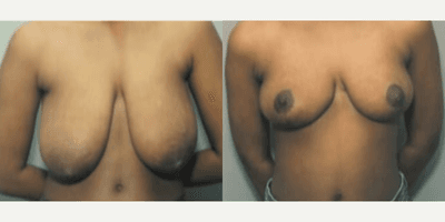 Case 8158 - Woman treated with Breast Reduction