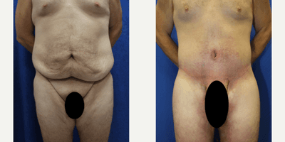 Case 8391 - 25-34 year old man treated with Body Lift