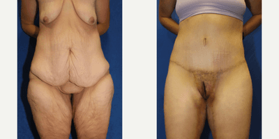 Case 8392 - 45-54 year old woman treated with Body Lift