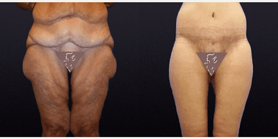 Case 8393 - 45-54 year old woman treated with Body Lift