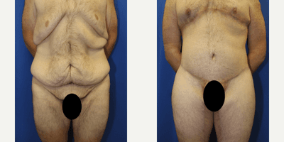 Case 8394 - 25-34 year old man treated with Body Lift