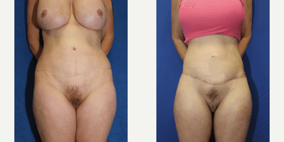 Case 8395 - 55-64 year old woman treated with Body Lift