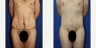 Case 8396 - 35-44 year old man treated with Body Lift