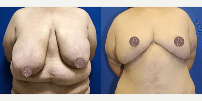 Case 8397 - 45-54 year old woman treated with Body Lift, Breast Augmentation