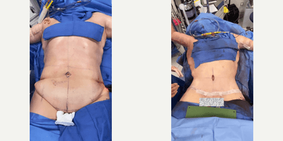 Case 8398 - 35-44 year old woman treated with Body Lift
