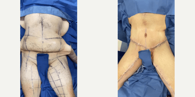 Case 8399 - 25-34 year old woman treated with Body Lift