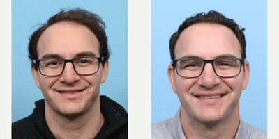 Case 8513 - 25-34 year old man treated with FUE Hair Transplant, Hair Transplant, Hair Loss Treatment, PRP for Hair Loss