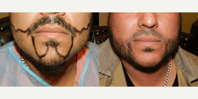 Case 8631 - 35-44 year old man treated with Beard Transplant
