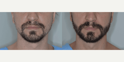 Case 8632 - Man treated with Beard Transplant
