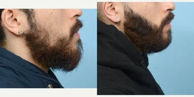 Case 8633 - 18-24 year old man treated with Hair Loss Treatment