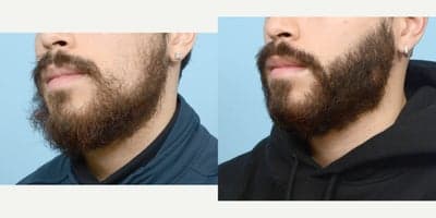 Case 8636 - 18-24 year old man treated with Beard Transplant