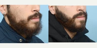 Case 8637 - 18-24 year old man treated with Beard Transplant