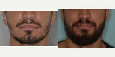 Case 8639 - 35-44 year old man treated with Beard Transplant, FUE Hair Transplant