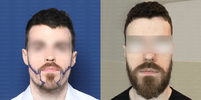 Case 8640 - 18-24 year old man treated with Beard Transplant