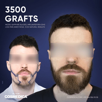 Case 8641 - 18-24 year old man treated with Beard Transplant